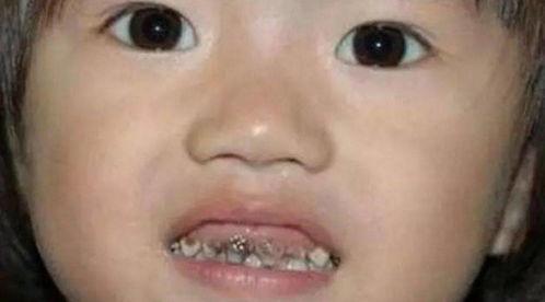 牙齿影响萌娃吃瓜,专家支招助力健康成长